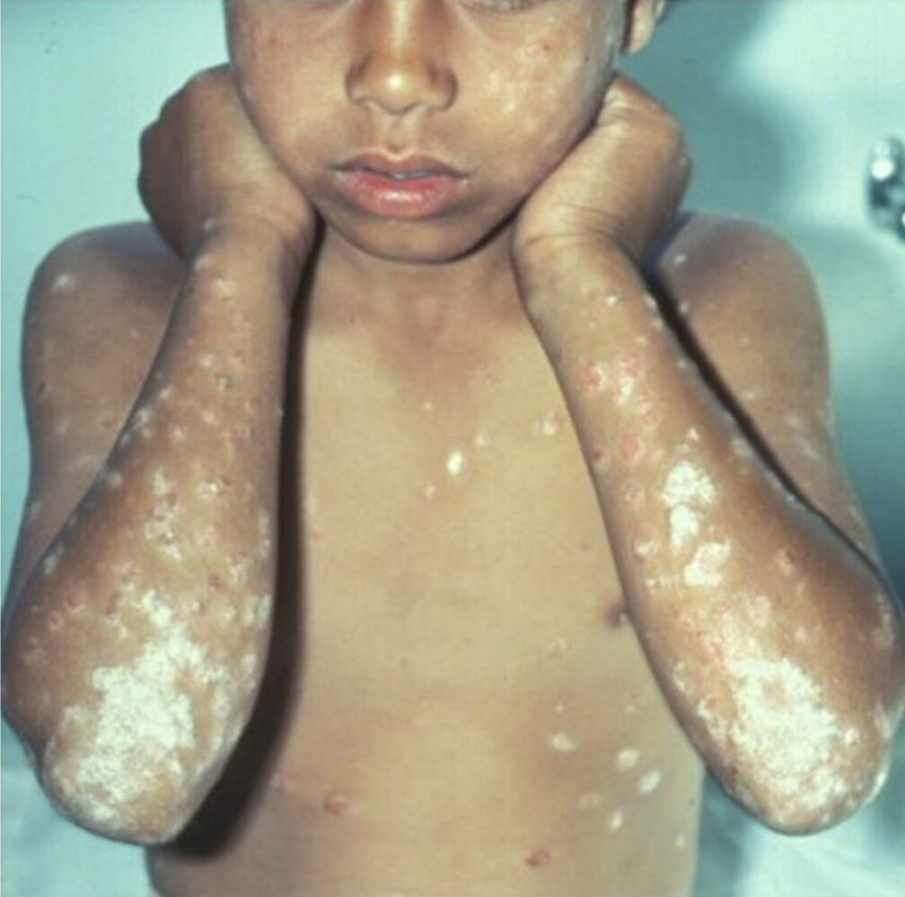 Psoriasis