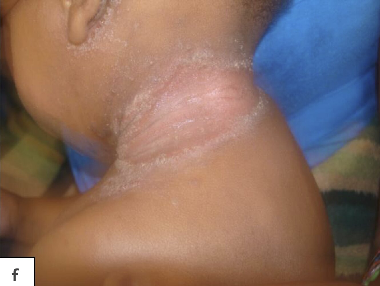 Seborrheic dermatitis
