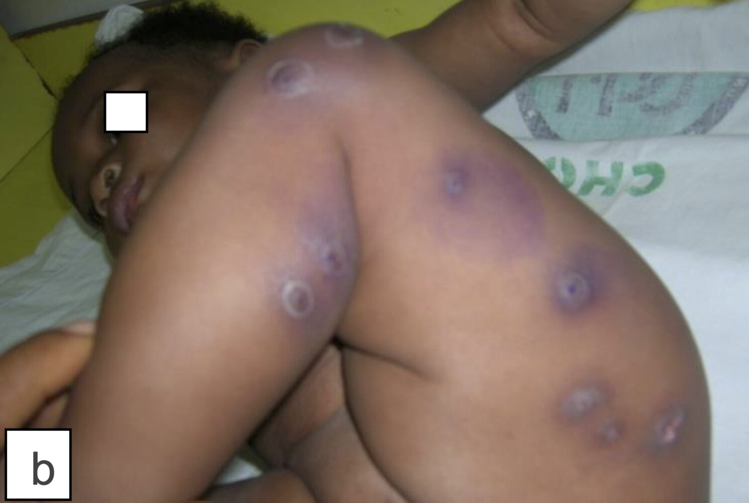 Myiasis