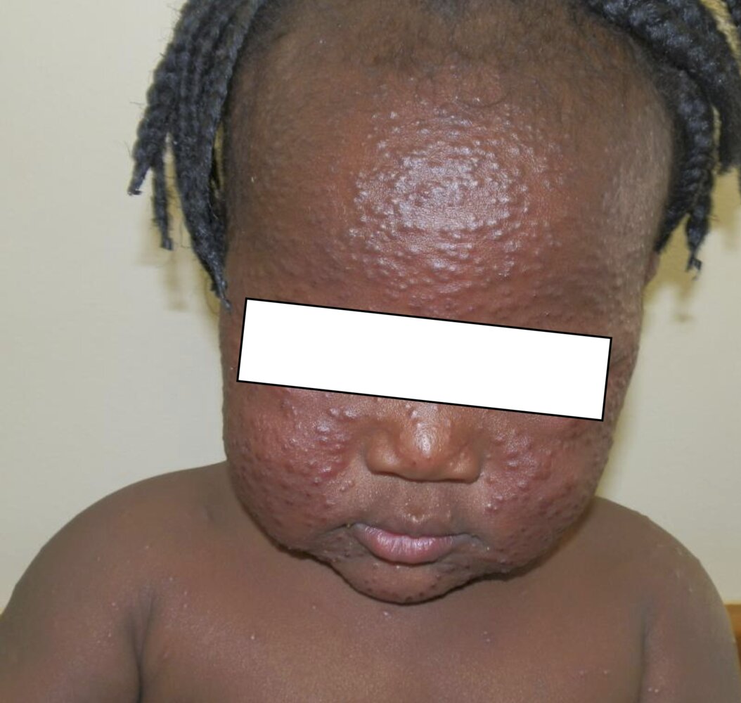 Eosinophilic folliculitis in a child with HIV infection