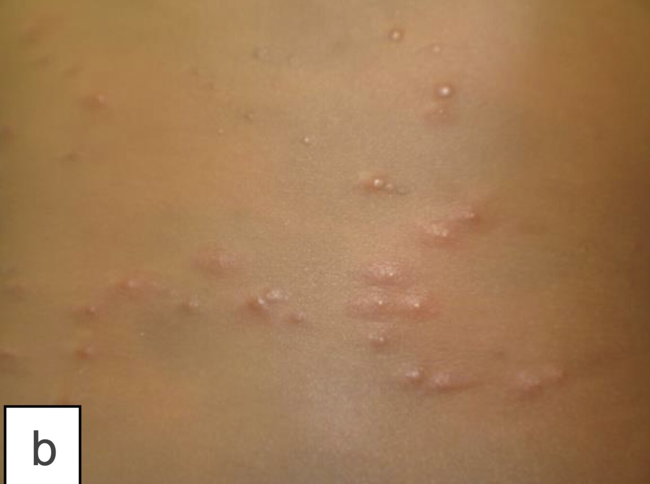 Papular urticaria