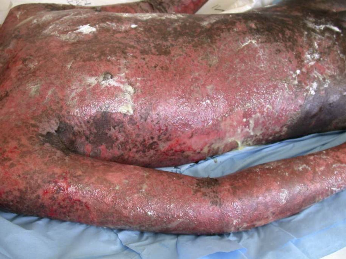 Toxic epidermal necrolysis (TEN)