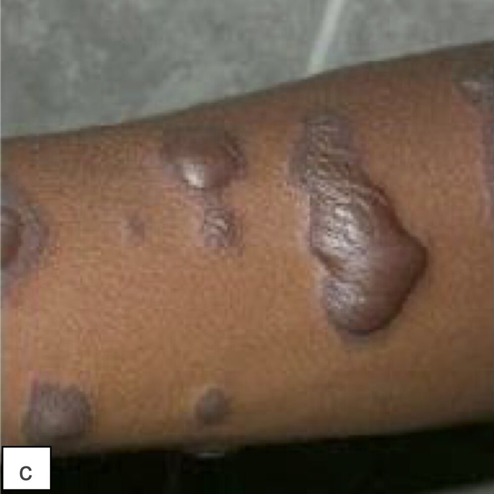 Fixed drug eruption