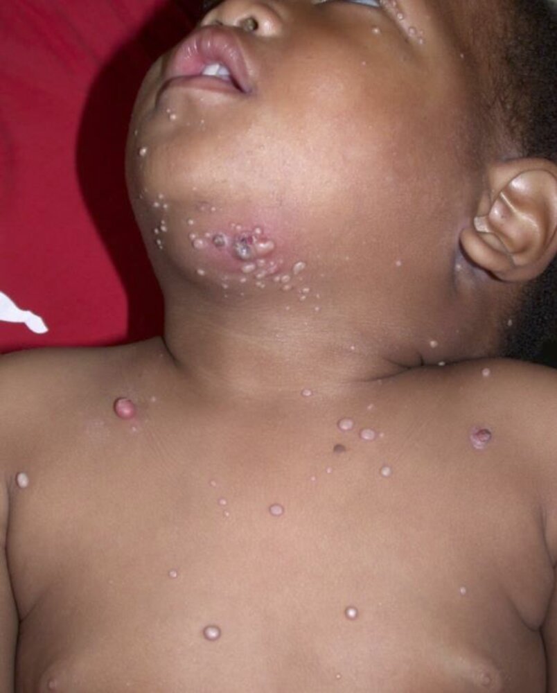Immune reconstitution inflammatory syndrome (IRIS)
