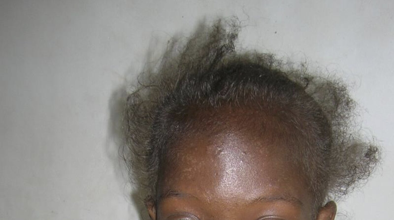 Hair changes in HIV