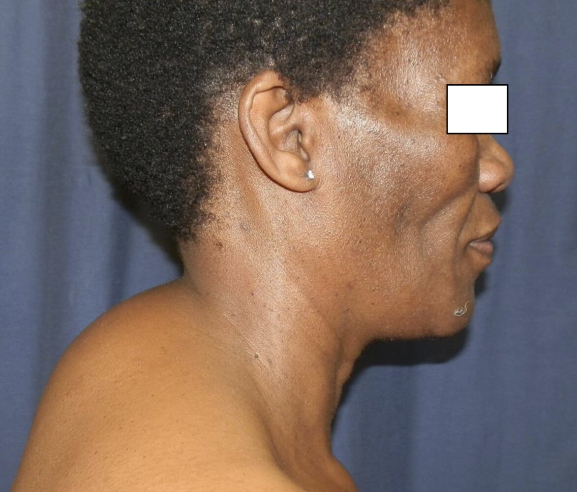NRTI-associated lipodystrophy