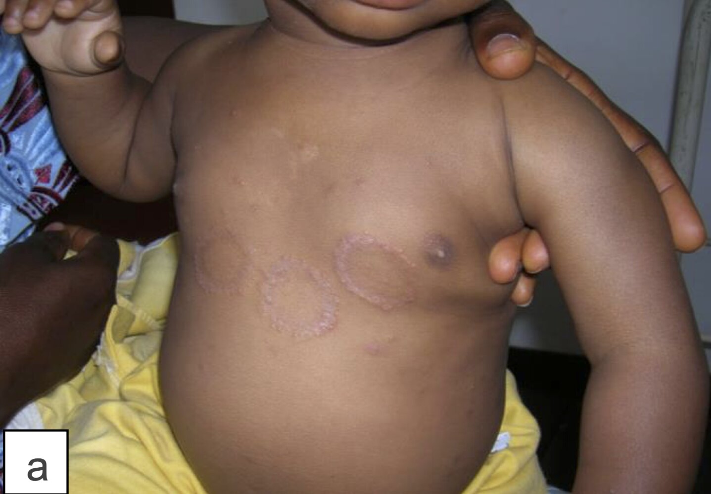 Tinea corporis
