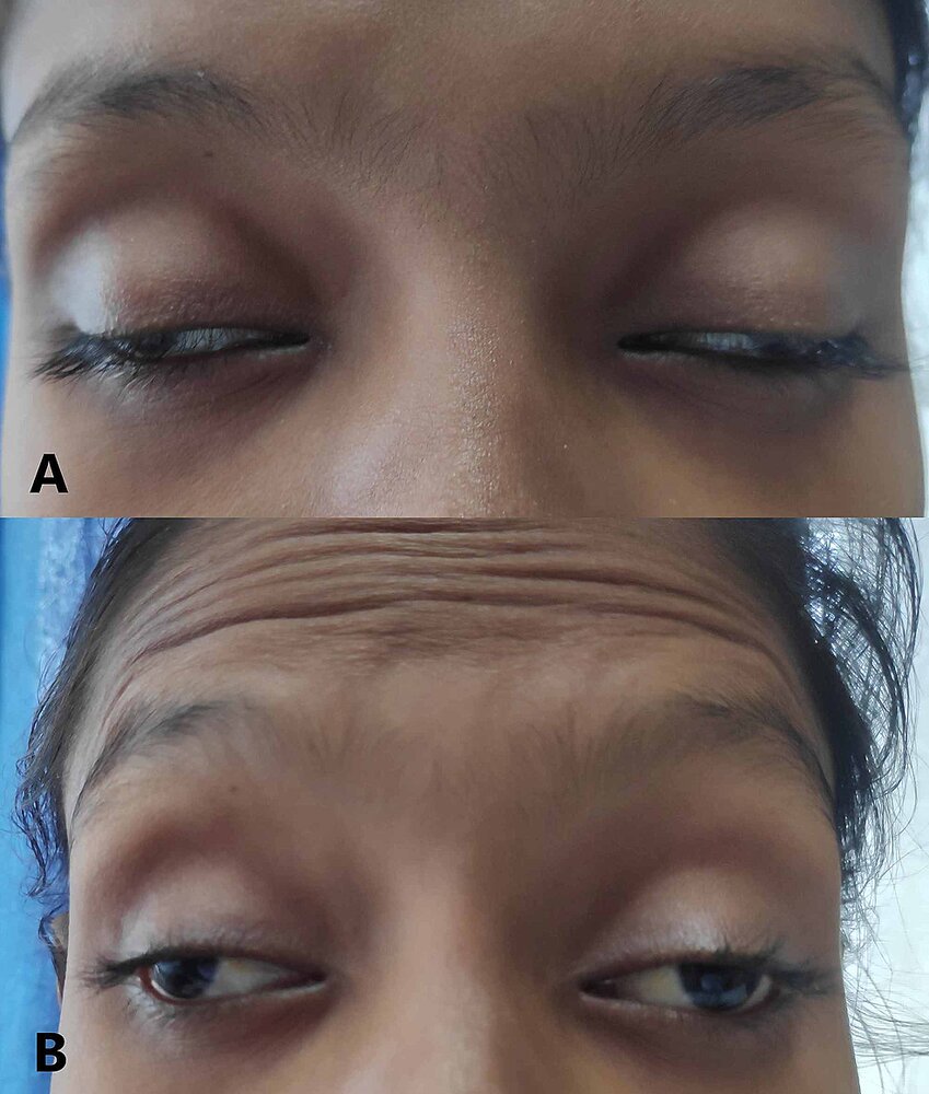 Bilateral complete oculomotor palsy
