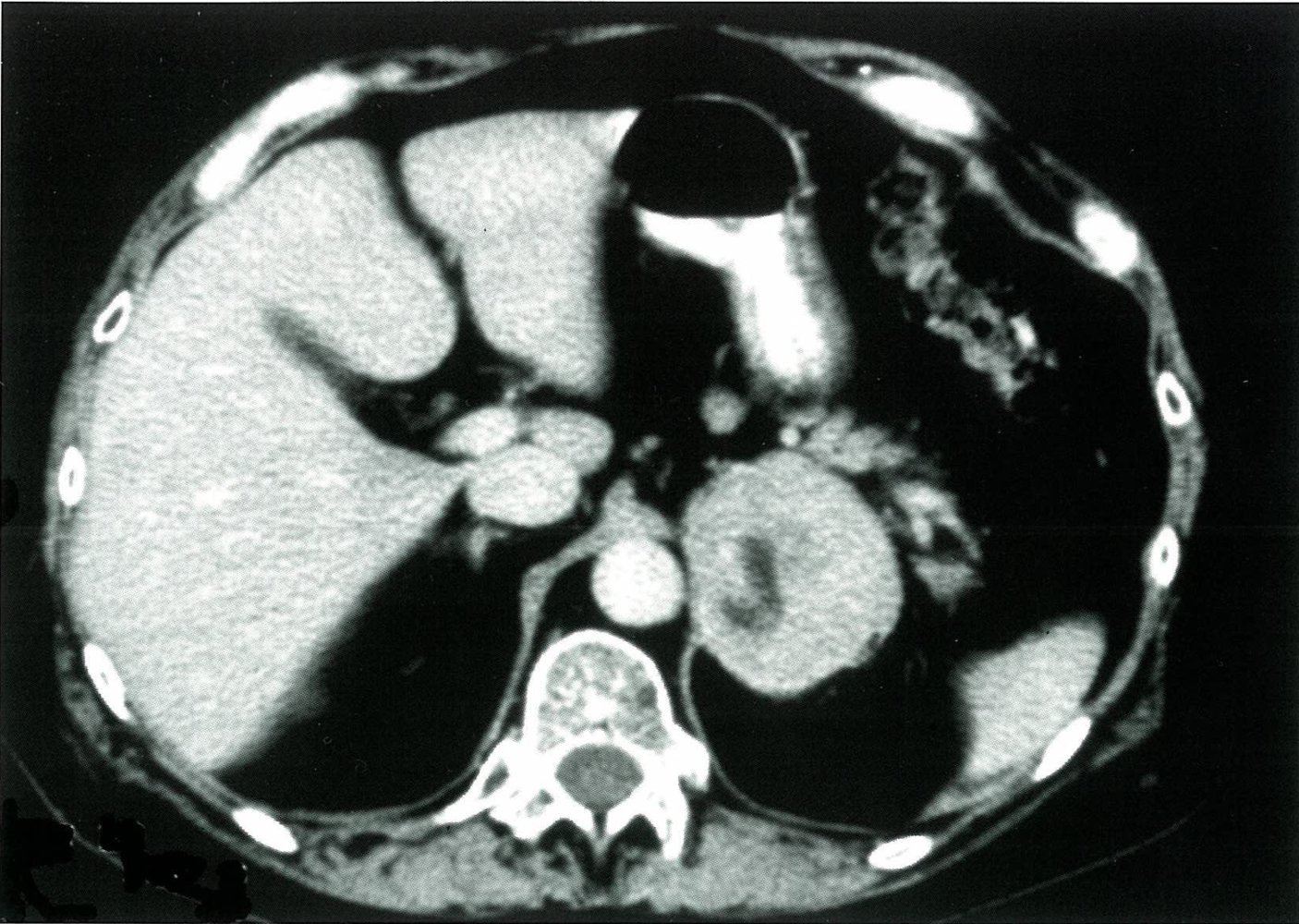 Left adrenal mass