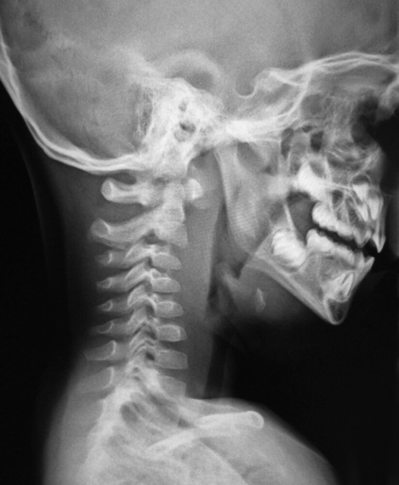 Deep neck infection