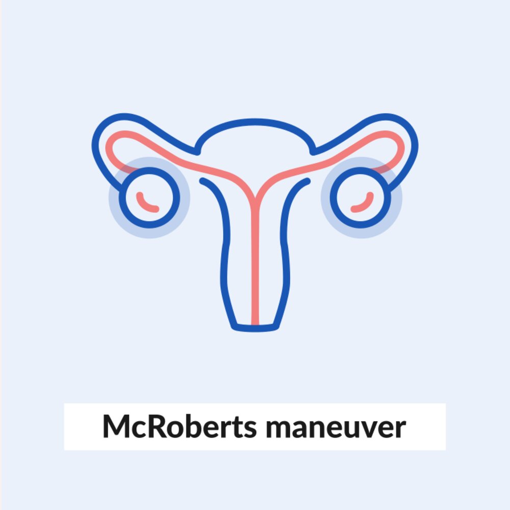 McRoberts maneuver