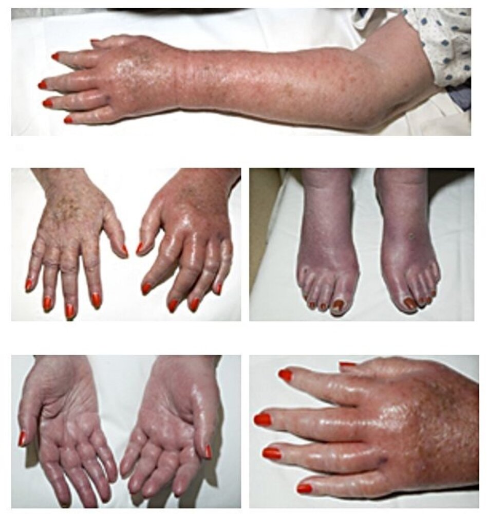 Erythromelalgia in polycythemia vera