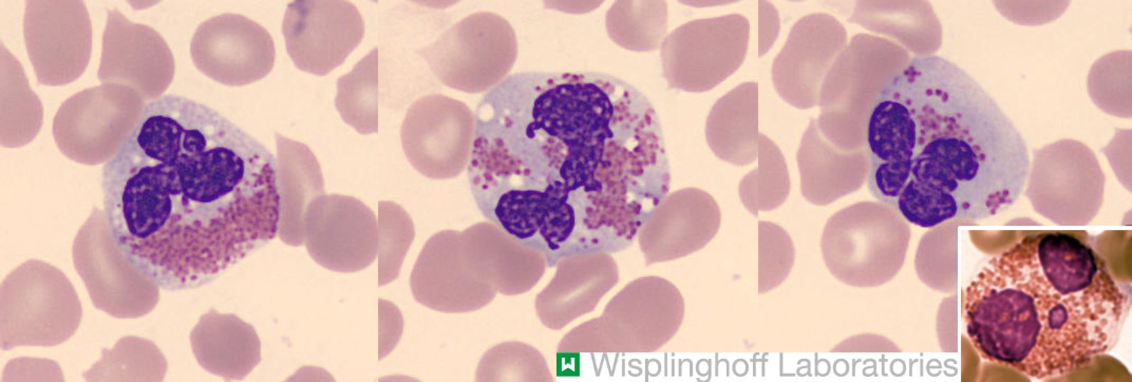 Chronic eosinophilic leukemia