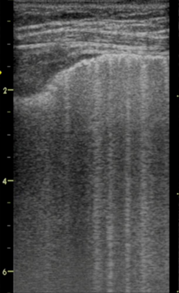 Multiple B-lines on lung ultrasound