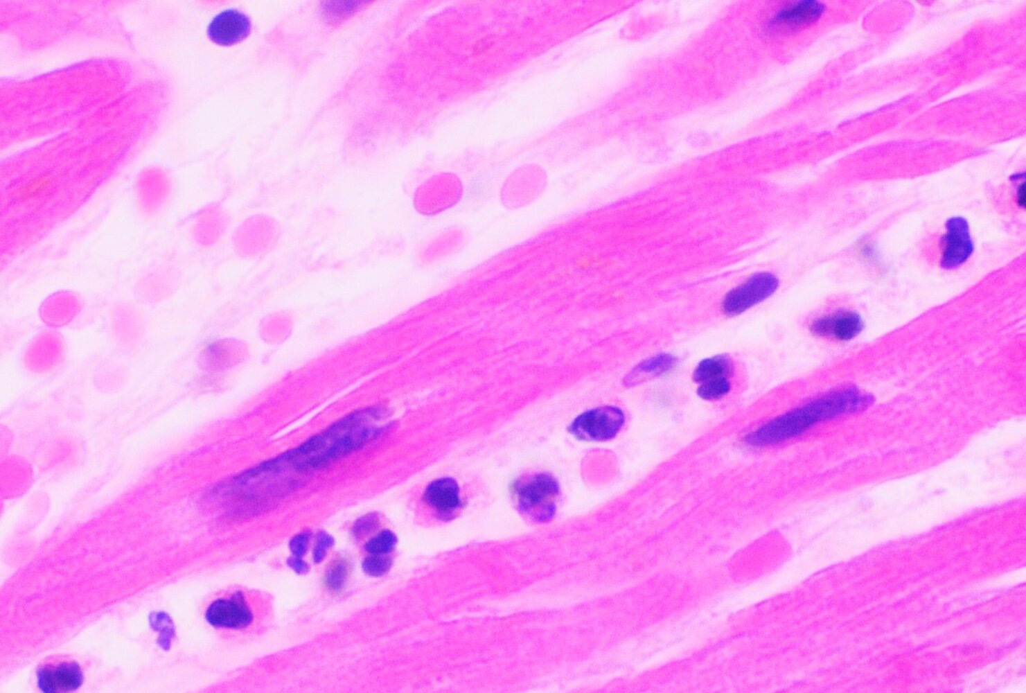 Myocardial infarction (extensive coagulative necrosis)