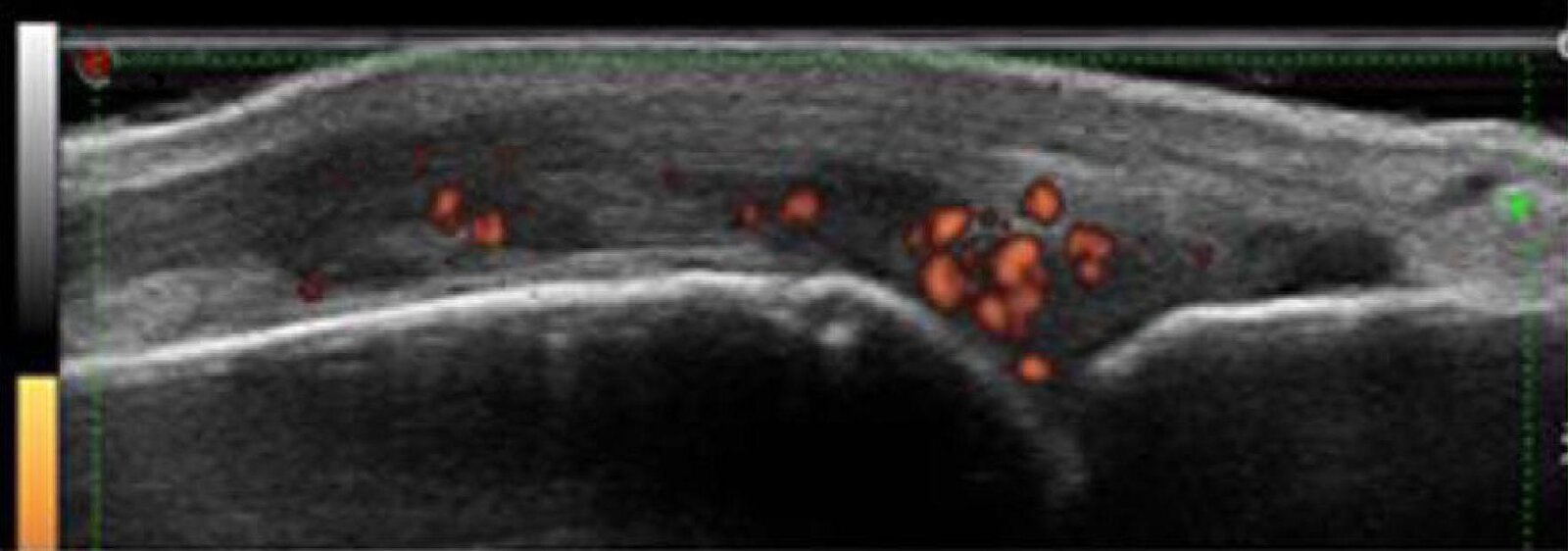 Synovial proliferation and inflammation in rheumatoid arthritis