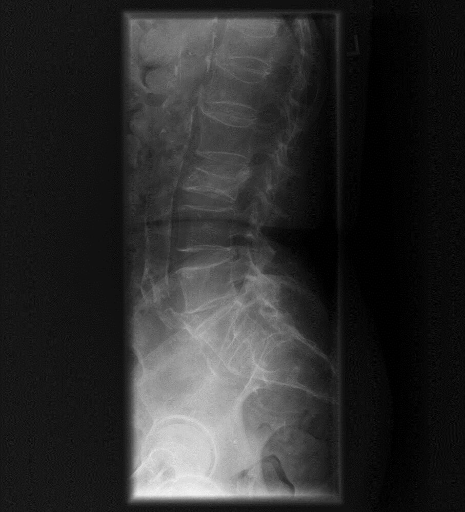 Vertebral compression fractures