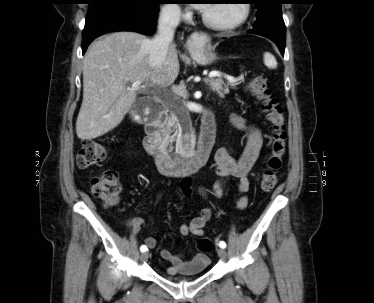 Choledocholithiasis with biliary obstruction