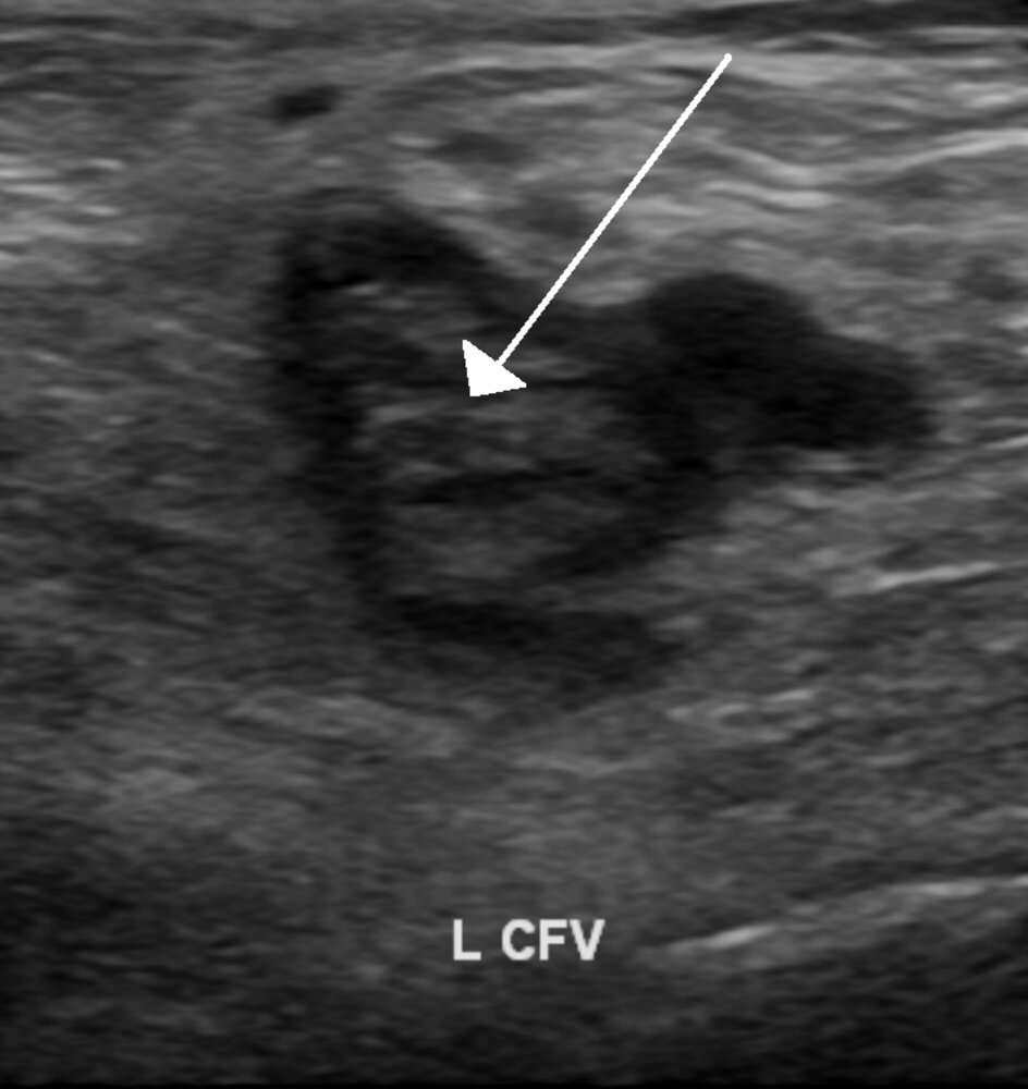 Ultrasound of deep vein thrombosis (DVT)