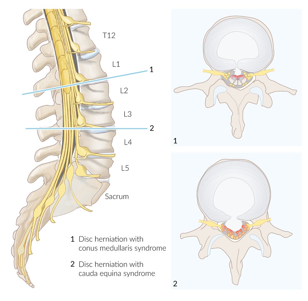 Conus medullaris and cauda equina syndromes