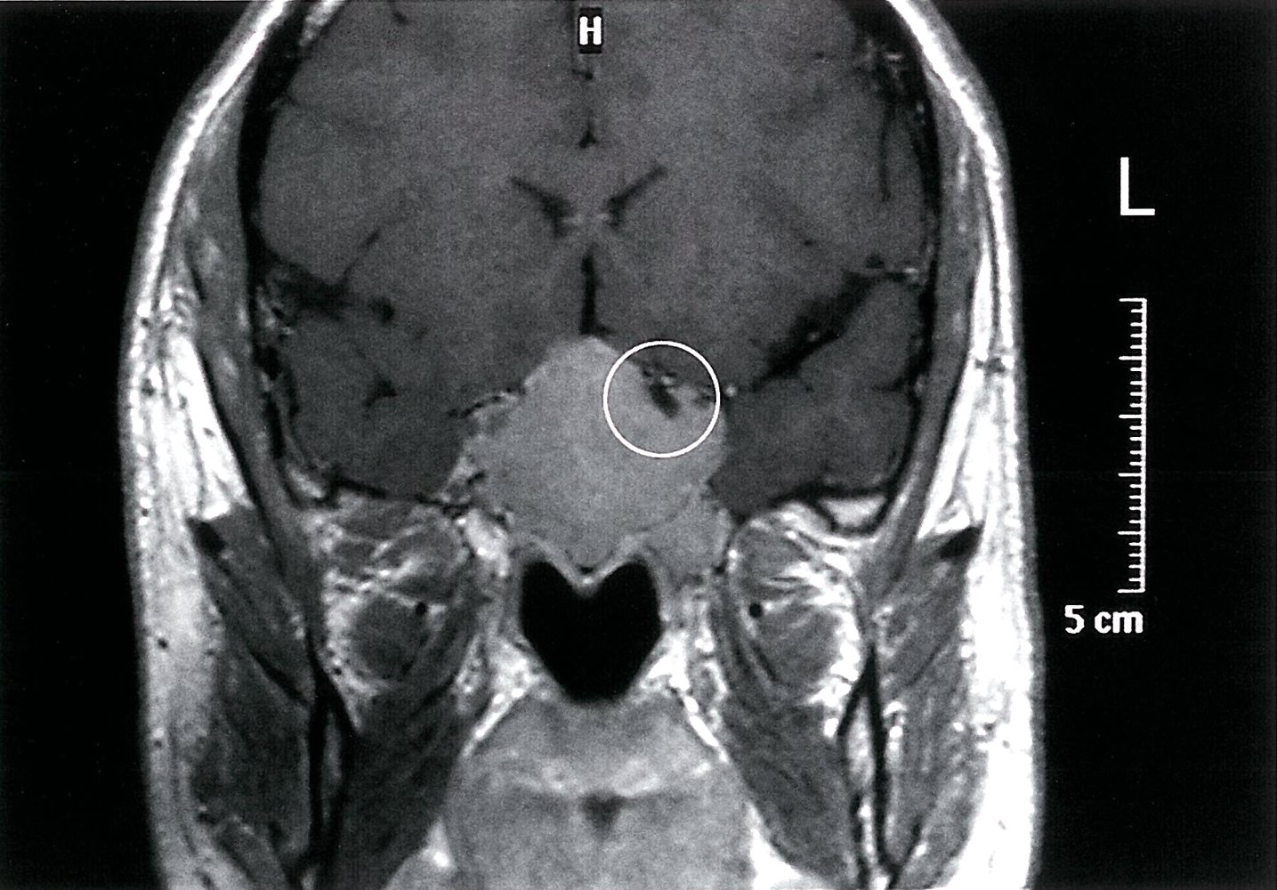Pituitary mass 1/2