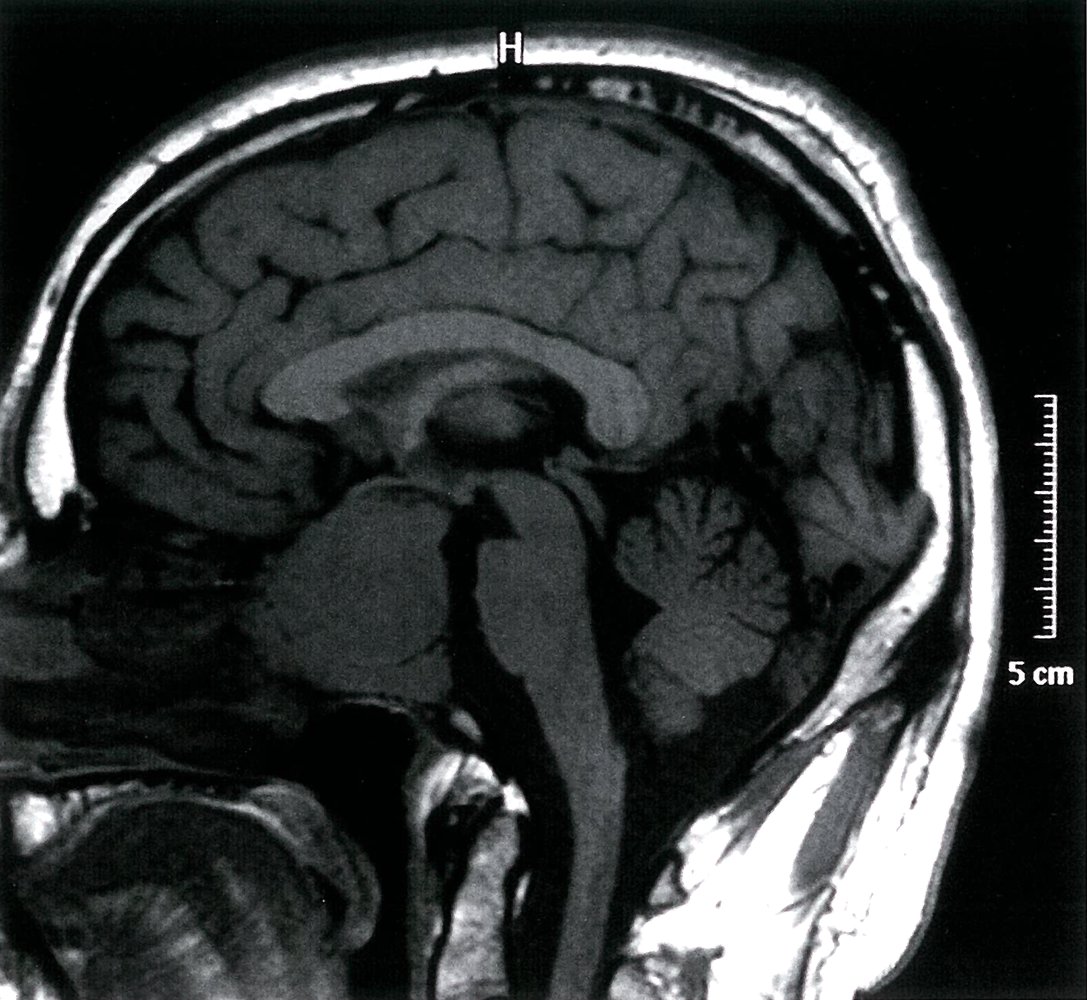 Pituitary mass 2/2