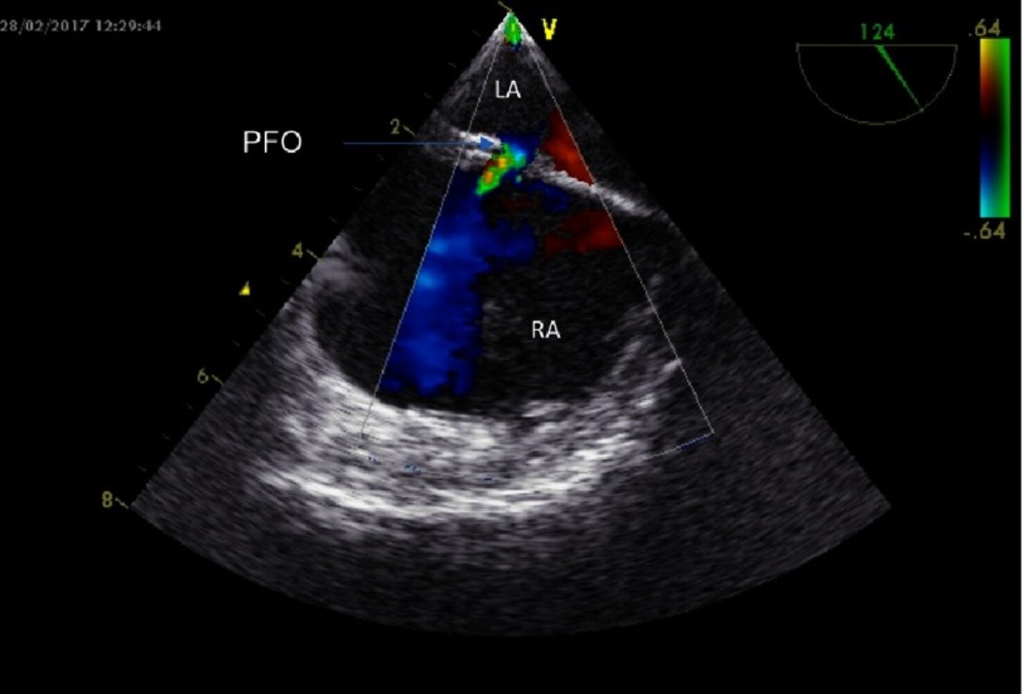 Patent foramen ovale