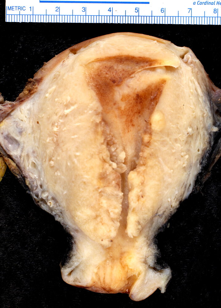 Endometrioid adenocarcinoma