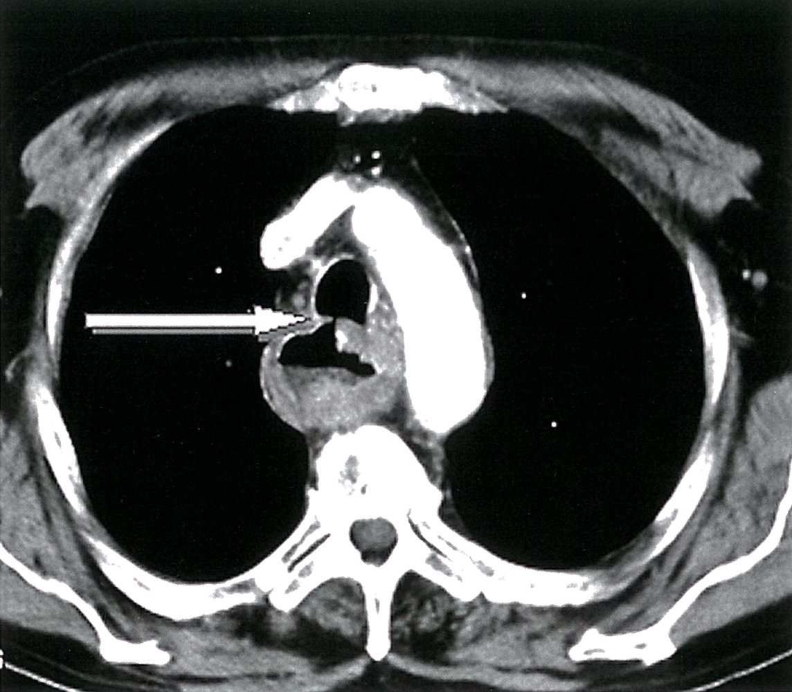 Esophageal cancer with tracheoesophageal fistula