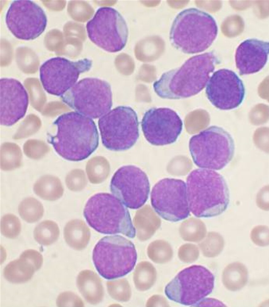 Acute lymphoblastic leukemia (ALL)