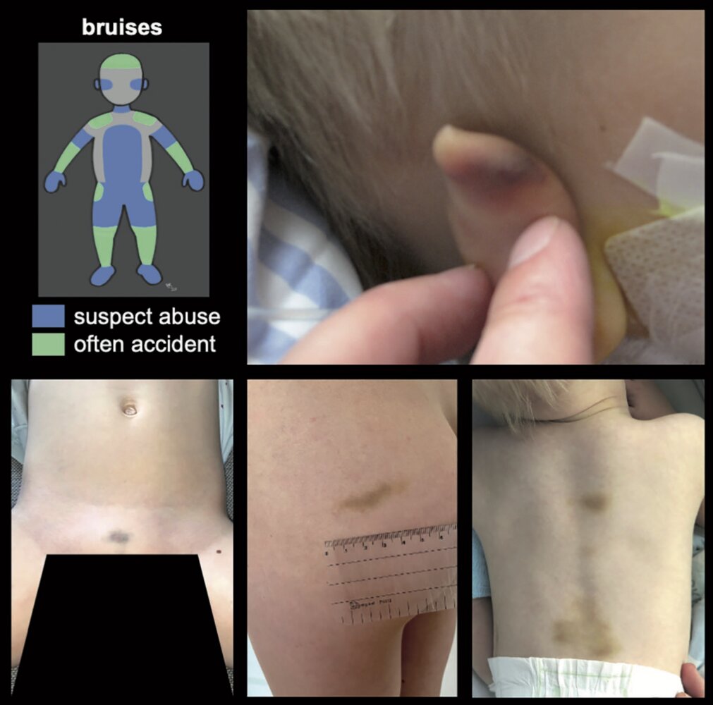 Bruise locations suspicious for child abuse