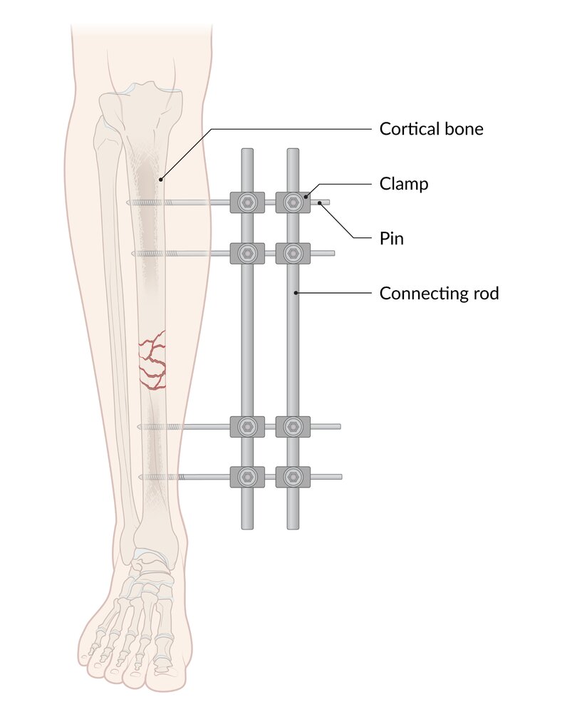 External fixation of a comminuted fracture of the tibia