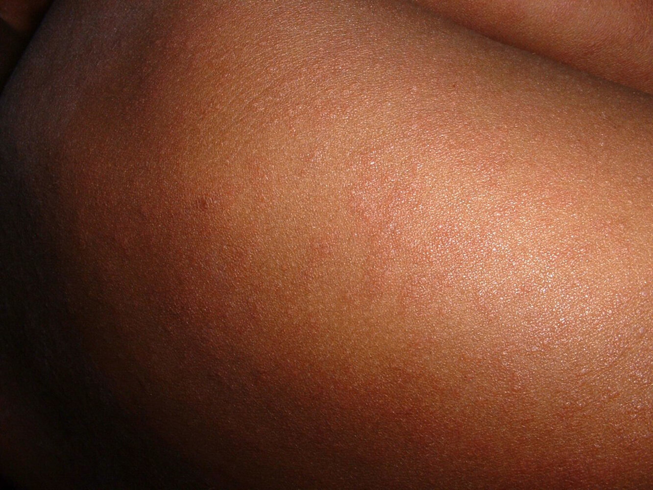 Measles rash