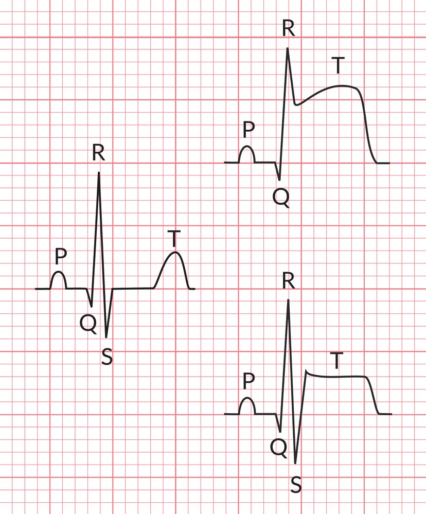 Types of ST-segment elevation