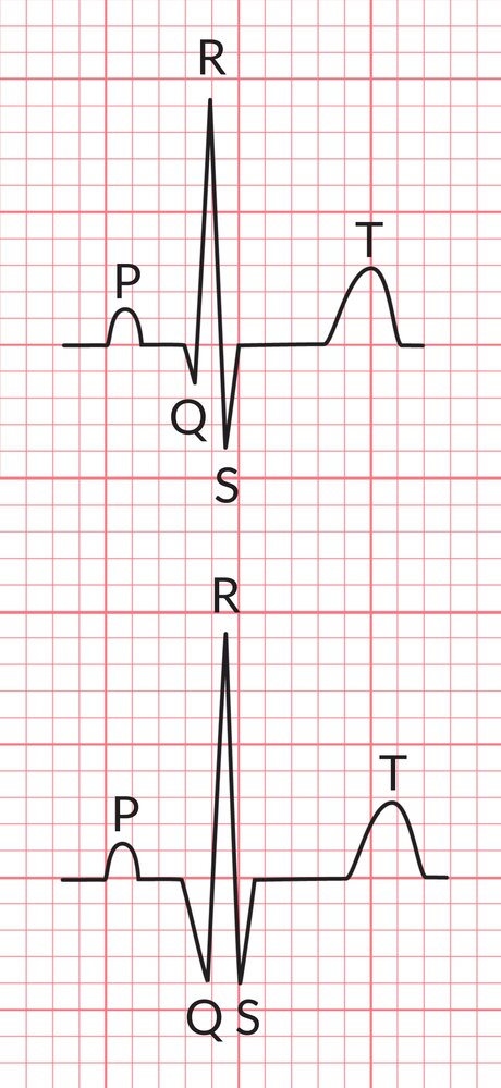 Pathological Q wave