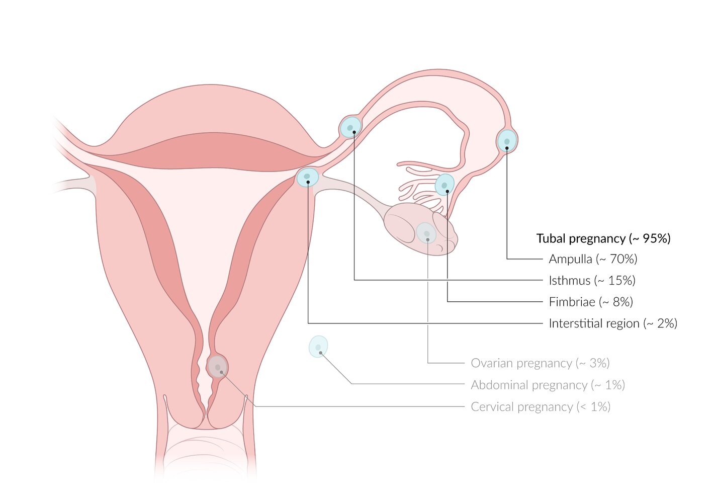 Sites of ectopic pregnancy