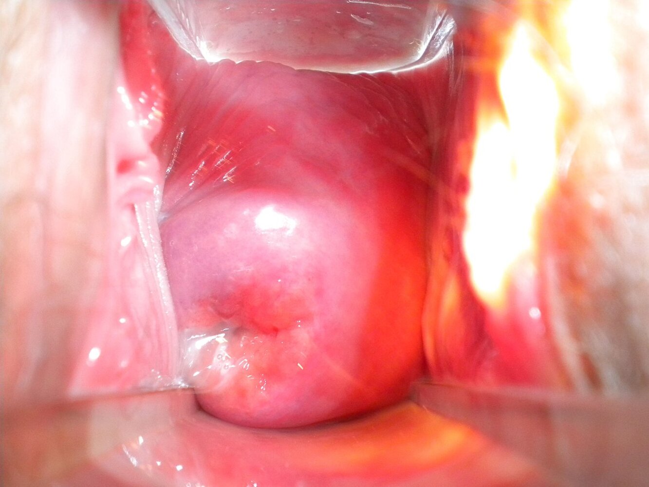 Cervical ectropion