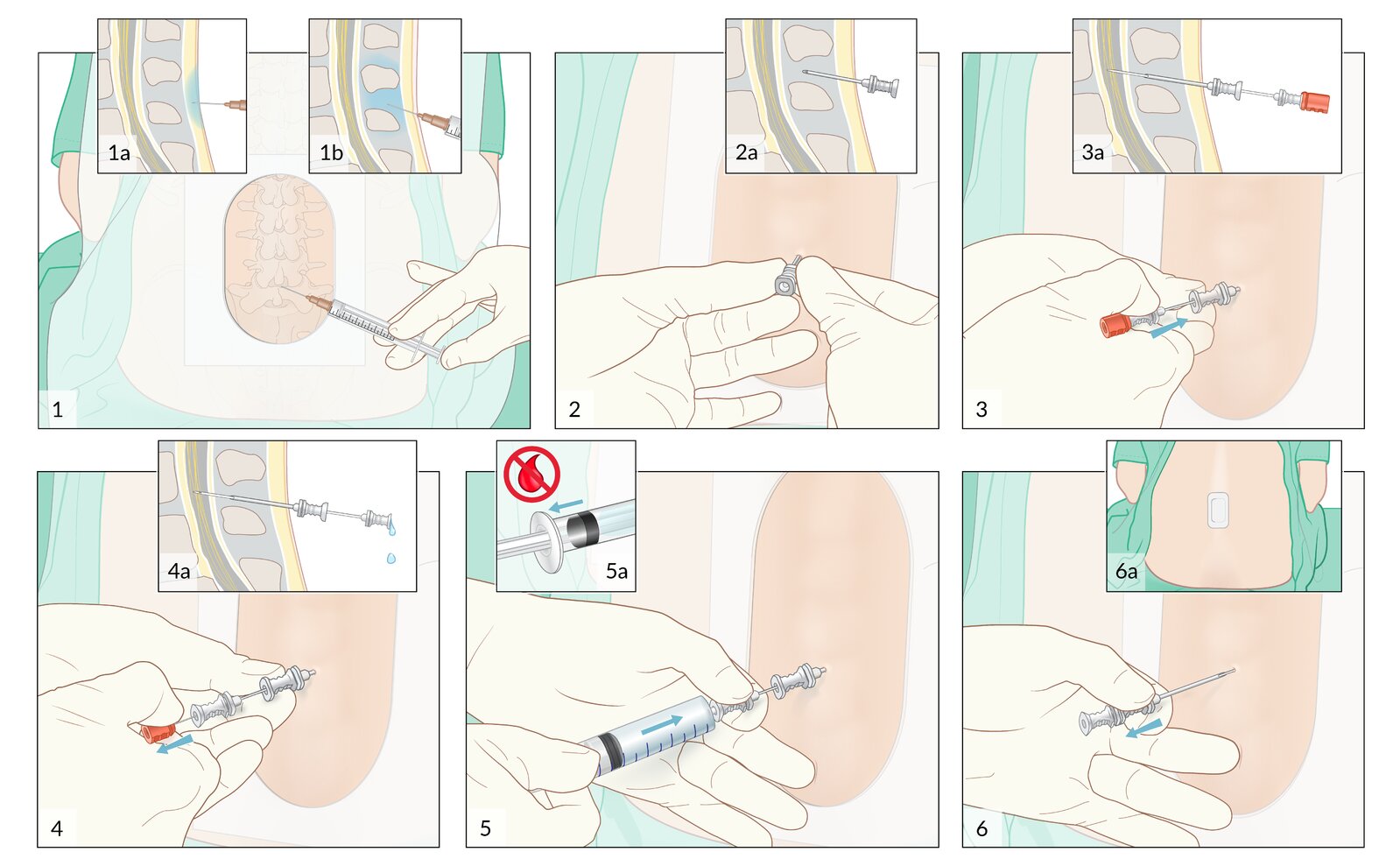 Spinal anesthesia (2/2): procedure