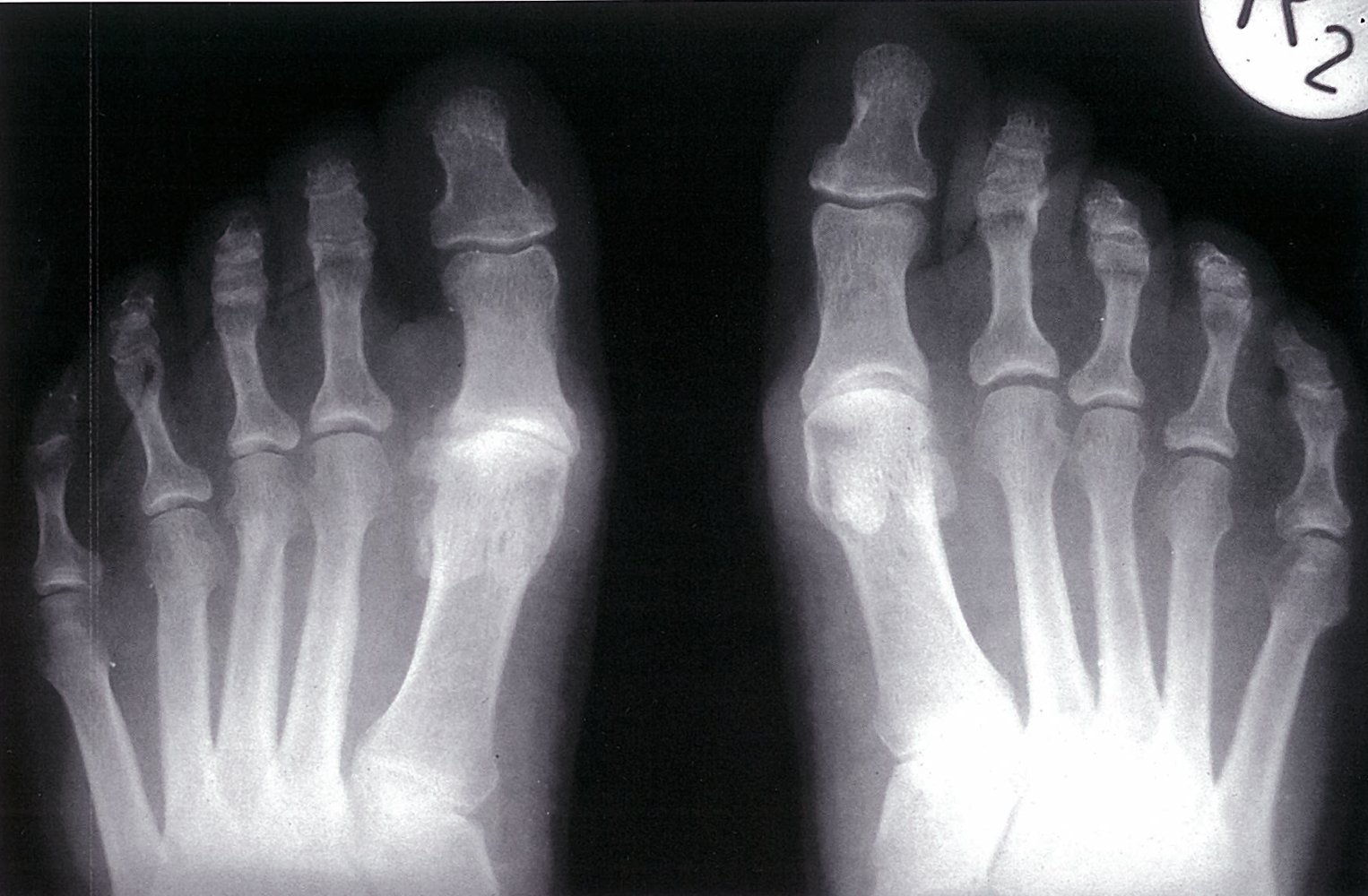 Advanced degenerative arthritis of the great toe metatarsophalangeal joint