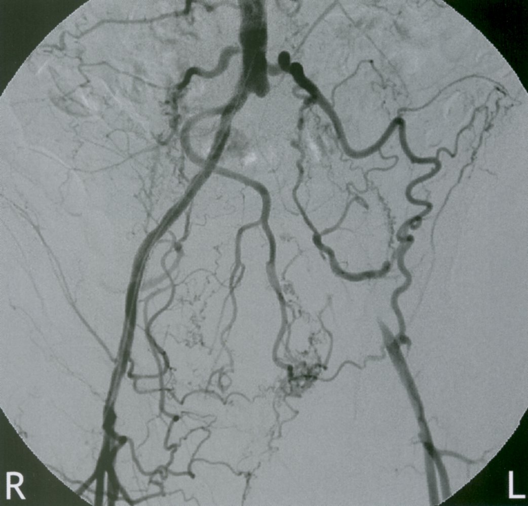 Peripheral arterial disease with iliac occlusion