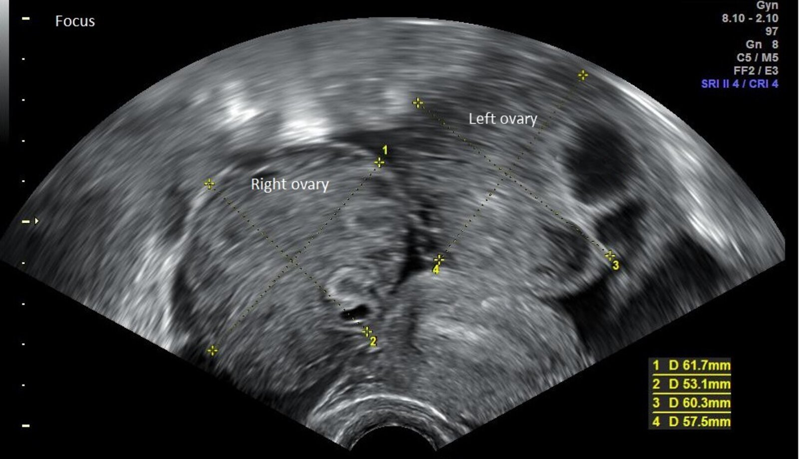 Transvaginal ultrasonography in ovarian hyperstimulation syndrome (1/2)
