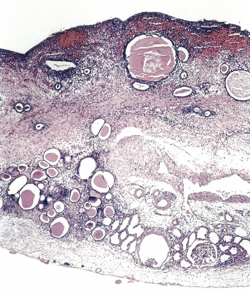Chronic pyelonephritis