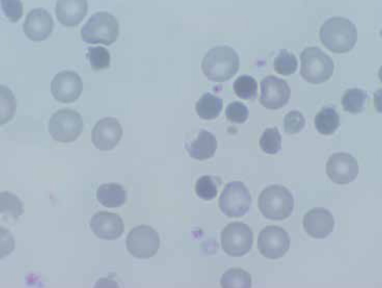 Bite cells in glucose-6-phosphate dehydrogenase (G6PD) deficiency