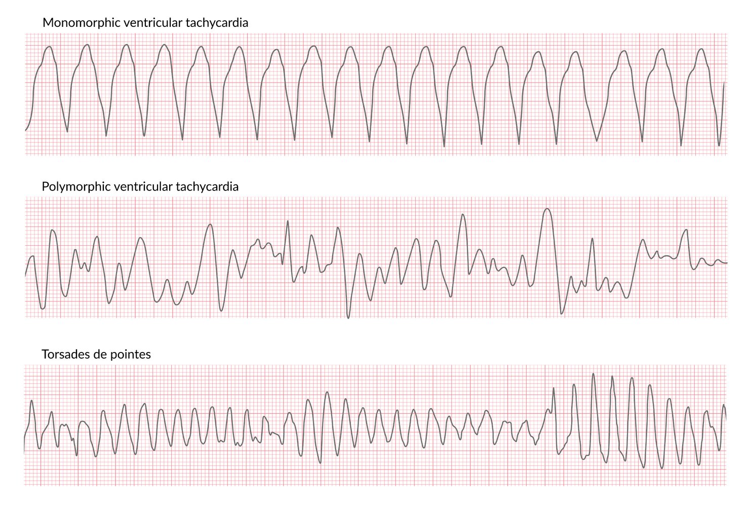 Comparison of monomorphic and polymorphic ventricular tachycardia (VT), including torsades de pointes