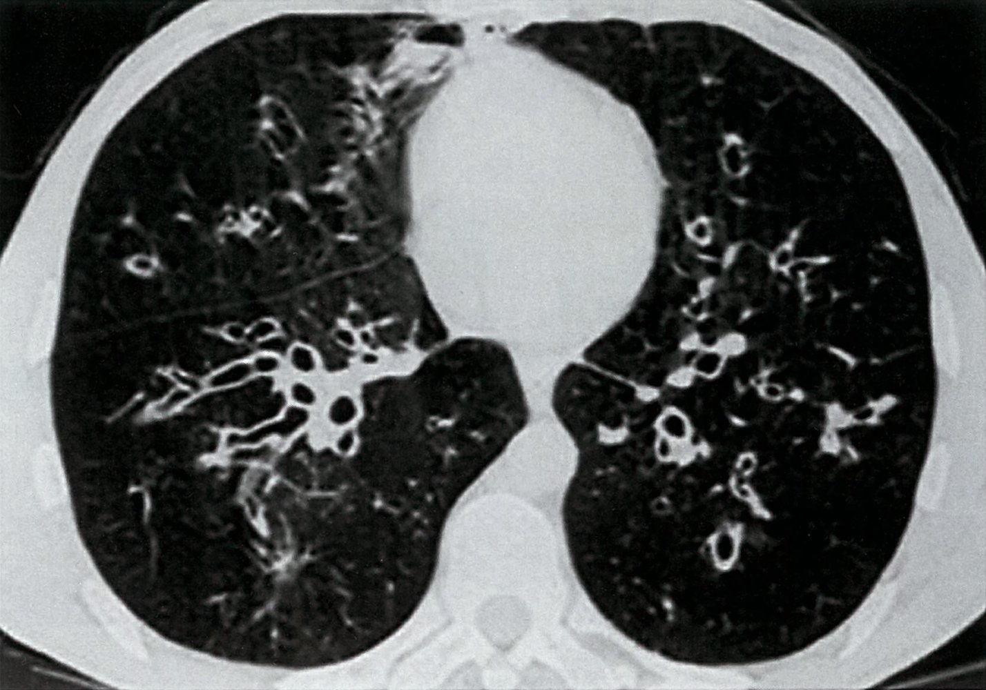 Bronchiectasis