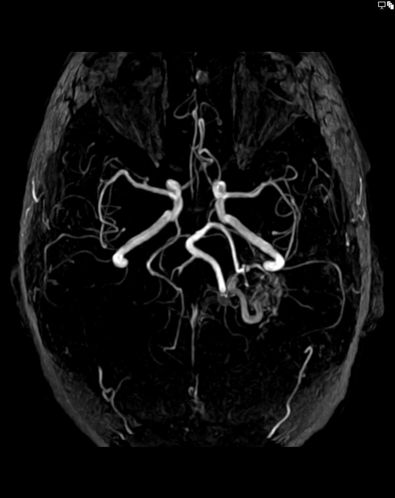 Cerebral arteriovenous malformation