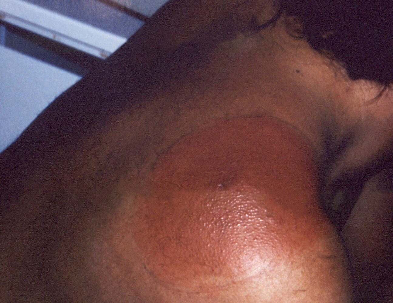 Erythema migrans