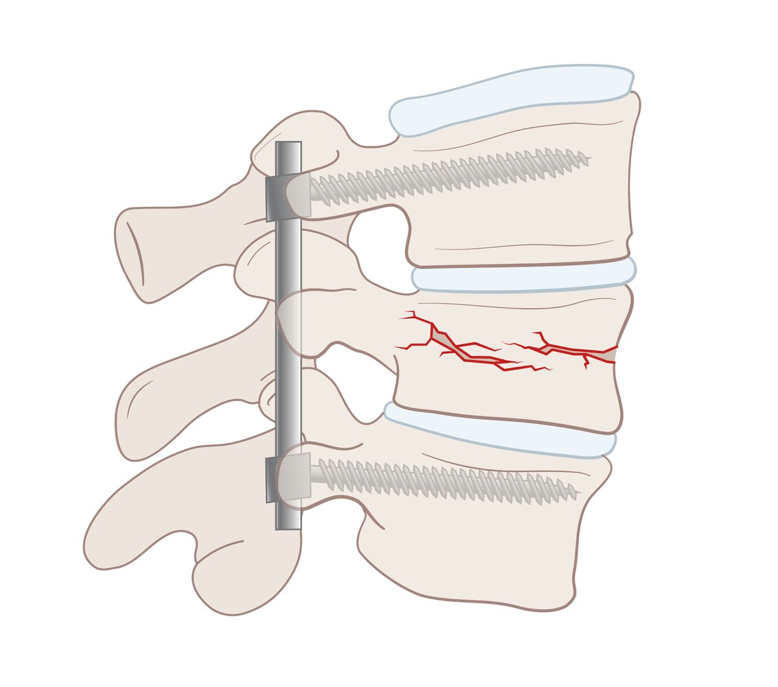 Internal fixation of a vertebral fracture