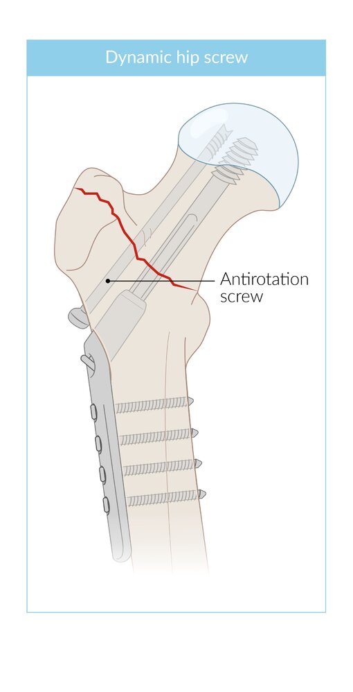 Dynamic hip screw