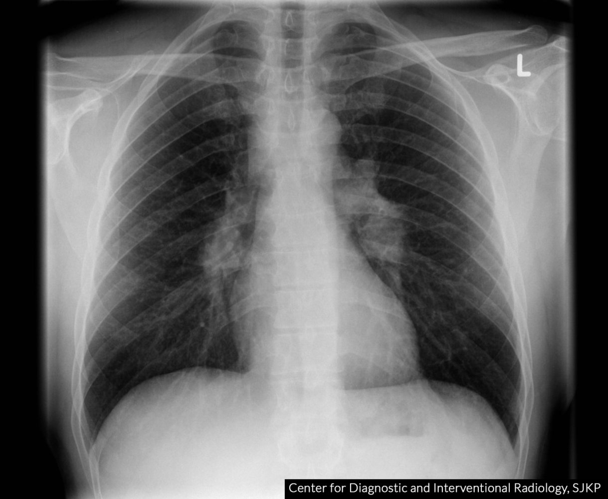 Bilateral hilar and right paratracheal lymphadenopathy